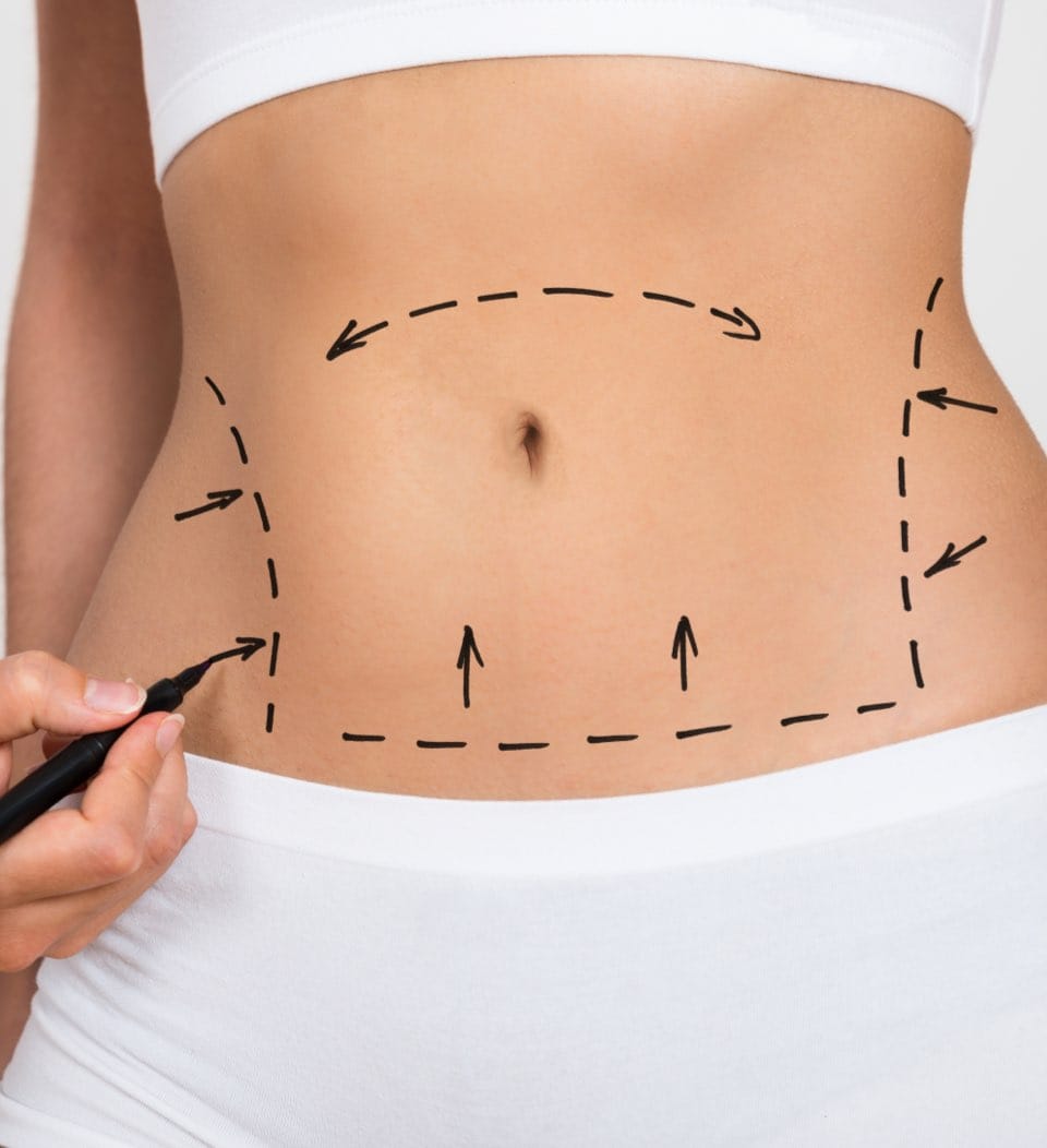 Person Hand Drawing Lines On A Woman's Abdomen As Marks For Abdominal Cellulite Correction